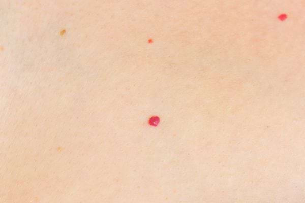 Gros plan d’un petit point rouge vif sur la peau claire.