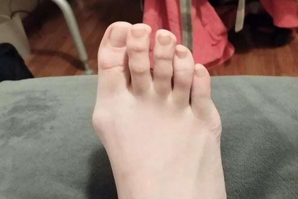 Gros plan d’un pied atteint d’hallux valgus.