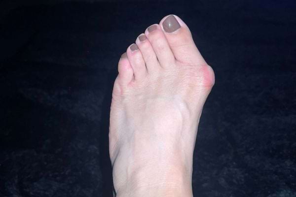 Pied avec oignon rouge et douloureux.