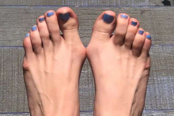 Pieds déformés avec hallux valgus sévère.