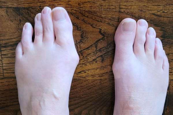 Deux pieds avec gros oignons.