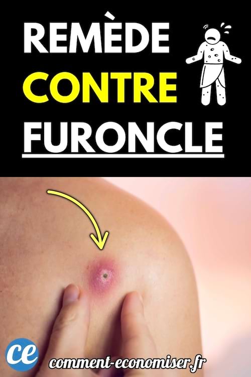 Un furoncle rouge et enflé sur la peau d’une épaule avec un doigt qui le touche.