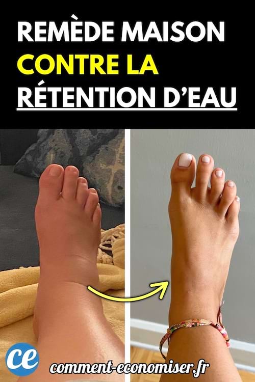 Comparaison de deux pieds, l’un gonflé et l’autre dégonflé, avec une flèche indiquant l’amélioration.