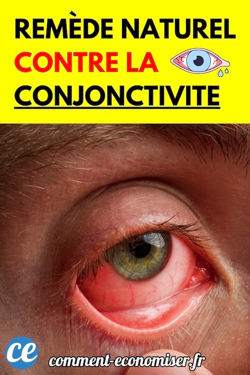 Un œil rouge et irrité avec les vaisseaux sanguins apparents.