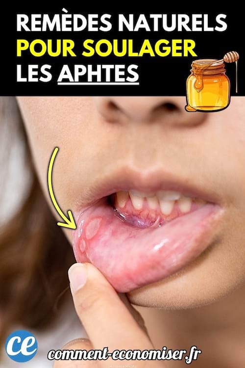Une bouche ouverte montrant un gros aphte sur la lèvre inférieure, avec un doigt qui tire la lèvre.