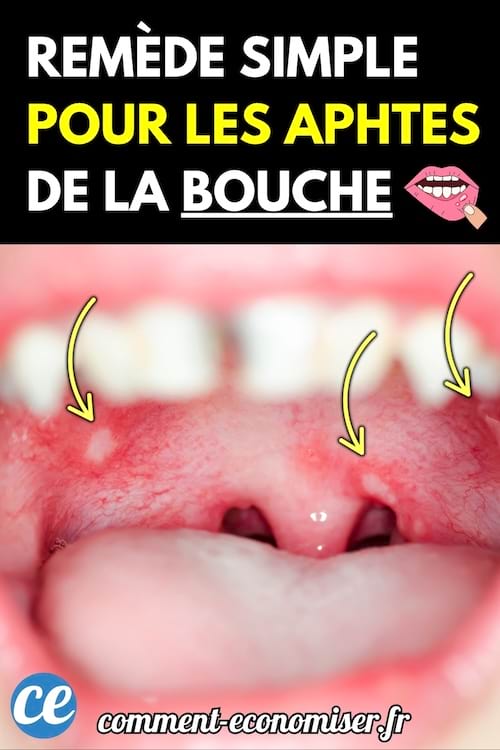 Intérieur de bouche montrant plusieurs aphtes sur la gencive avec des flèches jaunes pointant vers eux.