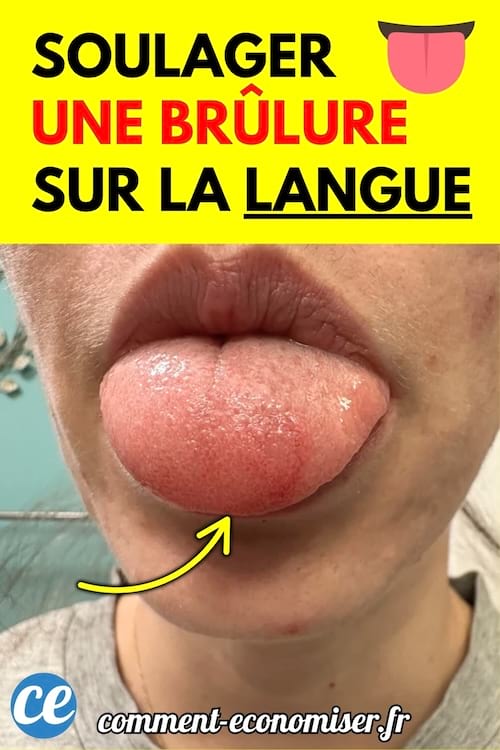 Une personne tire la langue pour montrer une brûlure visible sur la surface de la langue.