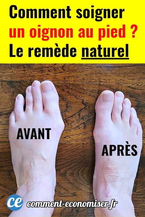 Un oignon de pied avant et après le remède naturel