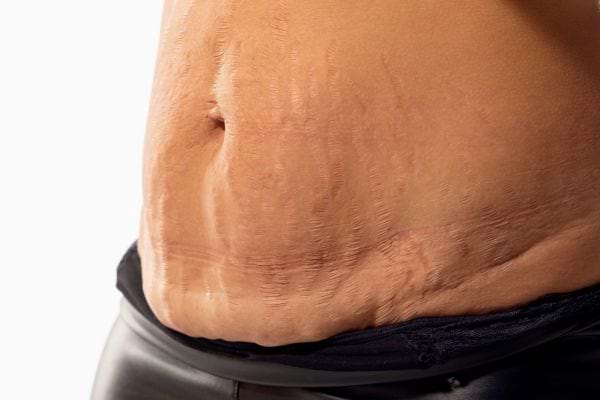Ventre avec vergetures visibles et relâchement cutané.