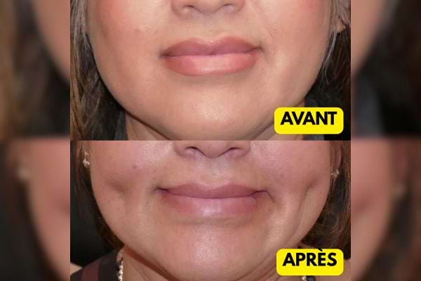 Joues de femme avant et après une chirurgie esthétique des fossettes