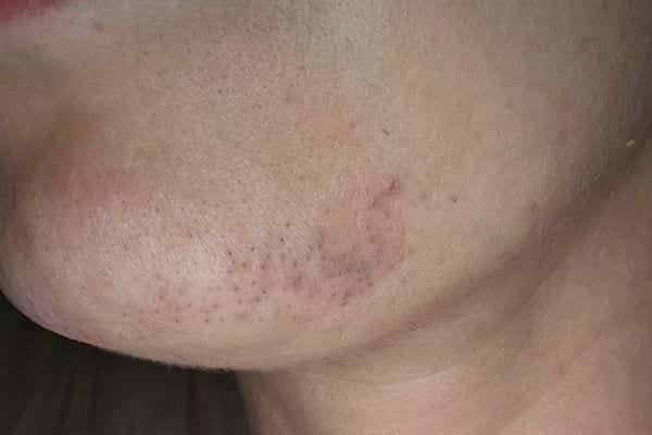 Menton marqué par cicatrices et poils incarnés visibles.