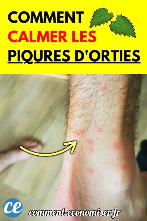 Jambe avec boutons rouges dus à des piqûres d’orties.