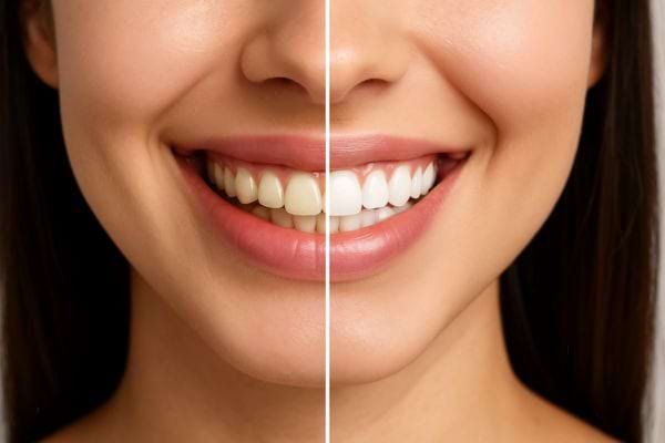 Des dents avant et après un soin blanchissant des dents