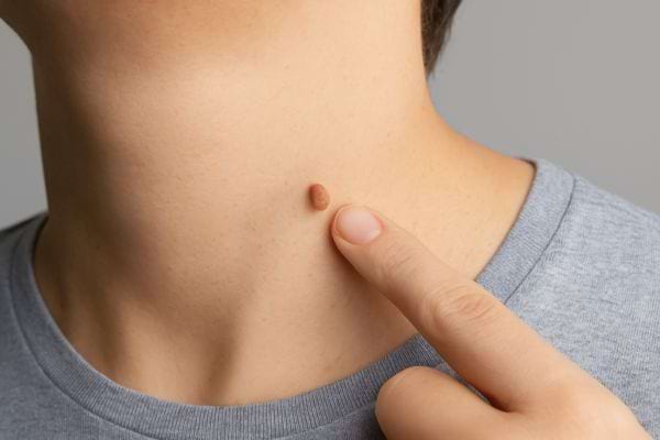 Doigt pointant un petit acrochordon au niveau du cou.