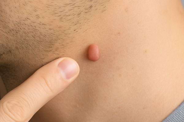 Gros plan d’un acrochordon sur la peau du cou.