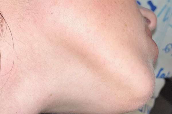 Menton féminin sans rougeur, peau nette et lisse après soins.