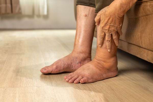 Des jambes et des pieds enflés d’une personne âgée assise sur une chaise.