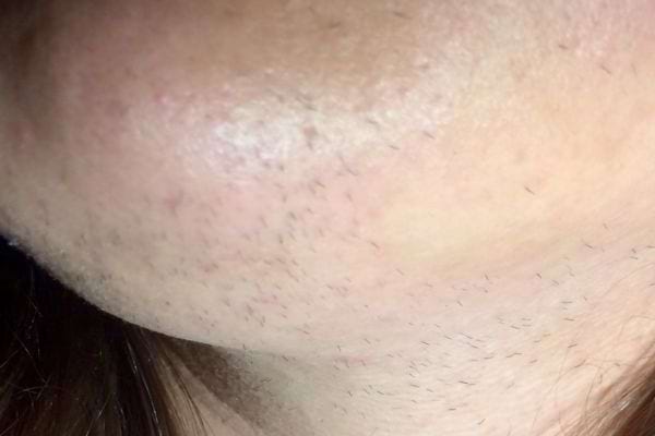 Menton avec pilosité excessive, poils courts et épars sur la peau.