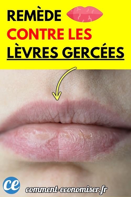 Lèvres sèches et gercées en gros plan.