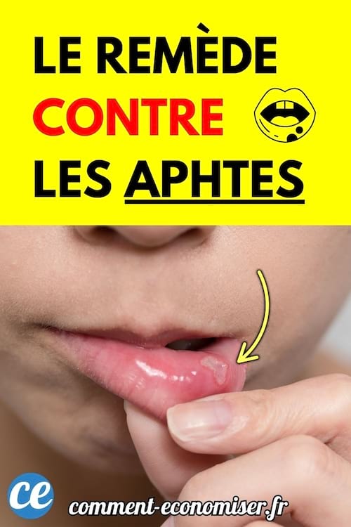 Un aphte visible à l’intérieur de la lèvre inférieure.