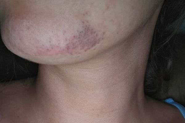 Menton irrité présentant rougeurs et poils incarnés après épilation.