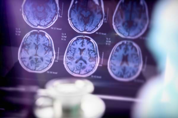 Scanner médical montrant plusieurs images du cerveau humain en gros plan.