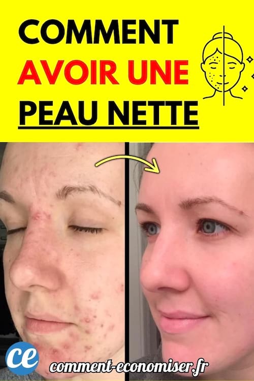 Femme avant avec acné et après peau lisse et nette.