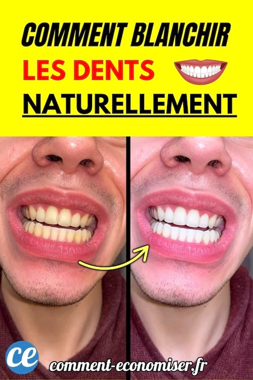 Avant après de dents plus blanches.