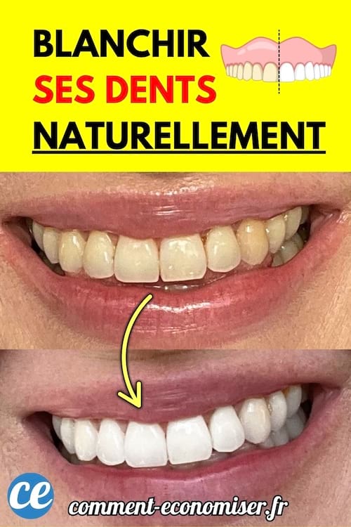 Gros plan sur un sourire montrant des dents avant et après blanchiment naturel.