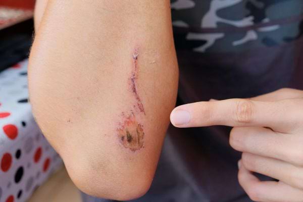 Une personne montre une plaie croûtée sur son coude légèrement infectée.