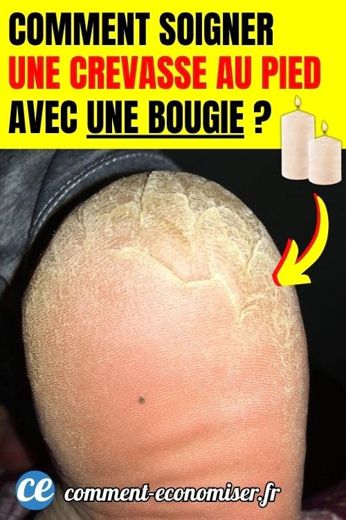 Un talon très sec avec des crevasses et des fissures.