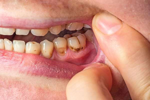 Gros plan sur des dents montrant une carie brune visible sur une molaire.