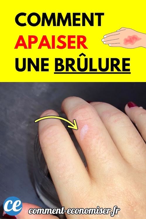 Main avec une petite br&ucirc;lure refroidie sous l&rsquo;eau.