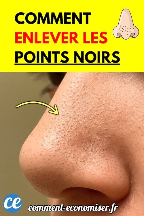 Nez avec plusieurs points noirs visibles sur la peau.