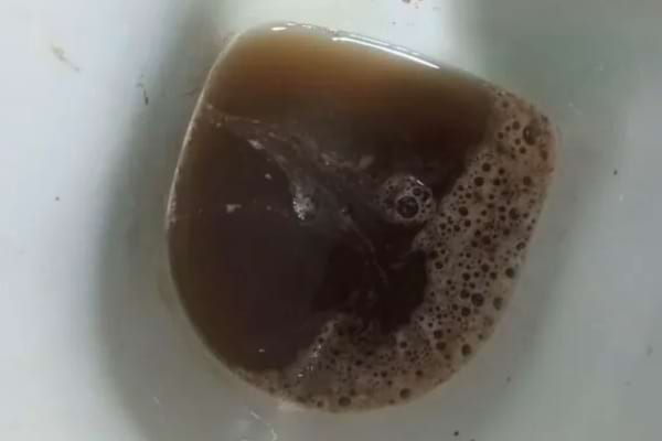 Urine brunâtre dans une cuvette de toilettes, signe d’une anomalie.