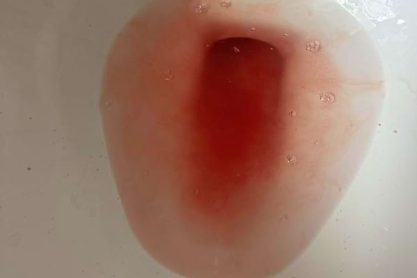 Urine teintée de rouge dans une cuvette de toilettes, évoquant un problème sérieux.
