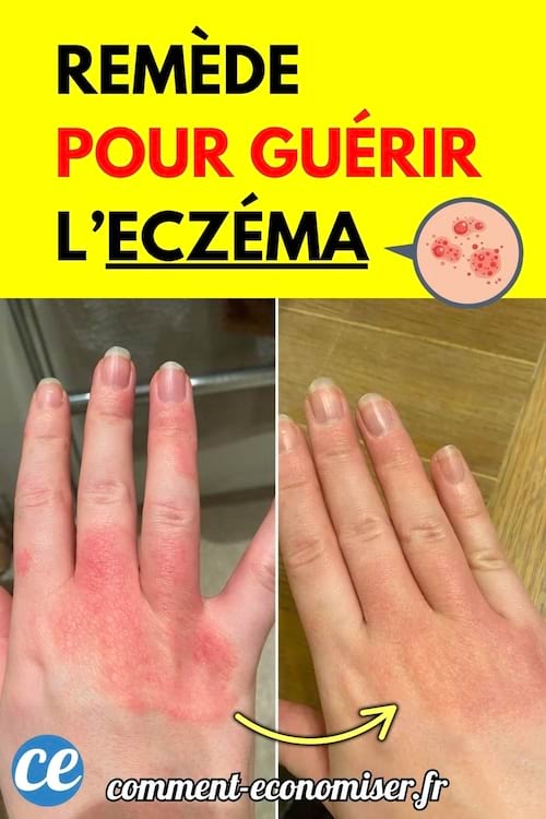 Main irritée avant et après traitement de l’eczéma.