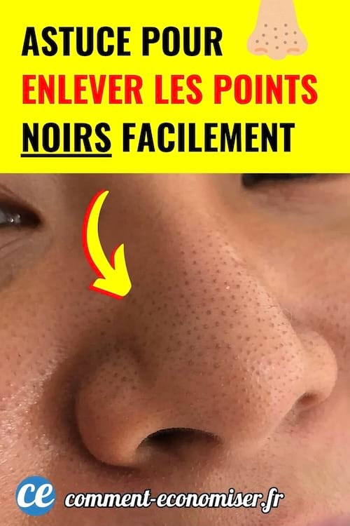 Nez avec de nombreux points noirs visibles, flèche jaune pointant la zone concernée.