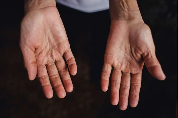 Deux mains sèches et abîmées sont montrées paumes ouvertes vers la caméra.