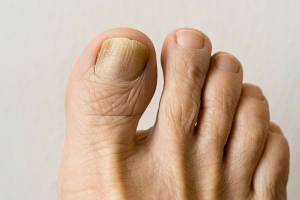 Gros plan sur un ongle de pied jauni, signe possible de mycose.