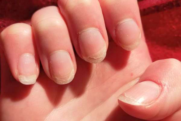 Une main montre des ongles cassants et dédoublés sous une lumière naturelle.