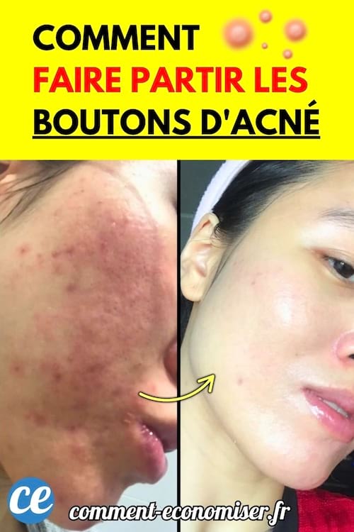 Avant après d'un visage avec des boutons d'acnés.