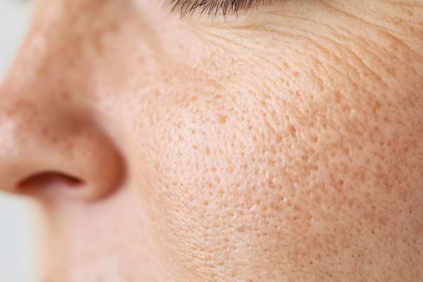 Peau du visage avec pores dilatés et texture visible en gros plan.