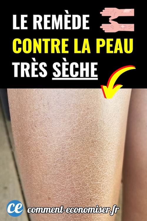 Gros plan sur une jambe présentant une peau très sèche avec texte coloré annonçant un remède efficace.