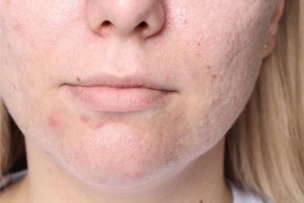 Gros plan sur un visage féminin présentant de l’acné et des rougeurs.