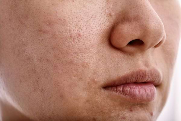 Gros plan d’un visage montrant des pores dilatés et des imperfections cutanées.