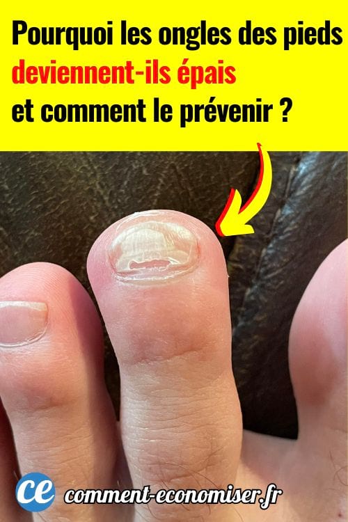 Un ongle de pied qui s'effrite et qui a durci