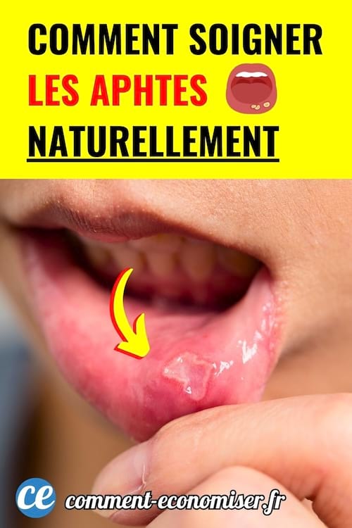 Gros plan sur une lèvre inférieure avec un aphte visible et une flèche rouge indiquant la zone.