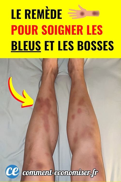 Jambes avec plusieurs bleus visibles sur les tibias.