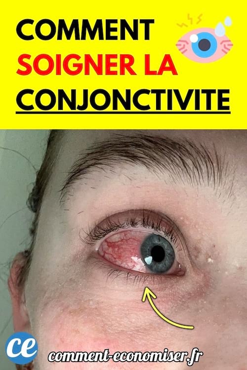 Œil rouge et irrité atteint de conjonctivite.